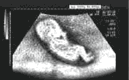 fetus driving